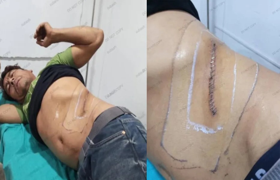 भारत लगेर रोजगारीको प्रलोभनमा मृगौला चोरी, दुधौलीका युवक पीडित