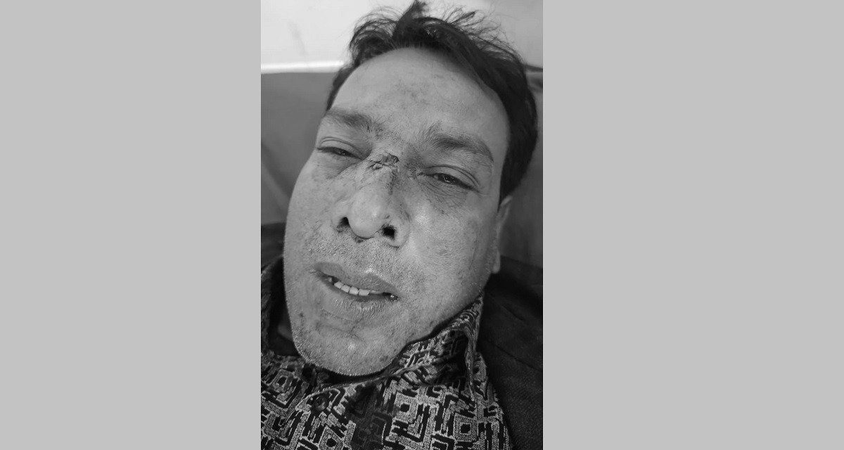 आजपाका समानुपातिक उम्मेदवारमाथि आक्रमण हुँदा नाकको हड्डी टुट्यो आजपाका समानुपातिक उम्मेदवारमाथि आक्रमण हुँदा नाकको हड्डी टुट्यो